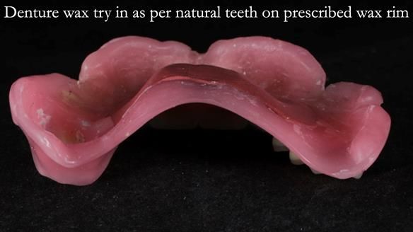 Finlay's Newsletter 58 Gasket upper partial denture for Zoe