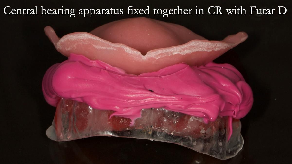 Newsletter 87 – Father Peter: A Partial Denture that needed Minor Miracle