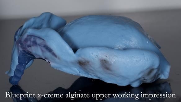 Newsletter 77: Jeremy’s case – immediate complete upper denture