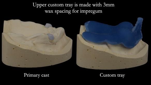 Newsletter 57 showcases the making and fitting process of implant-supported complete dentures for Alisdair