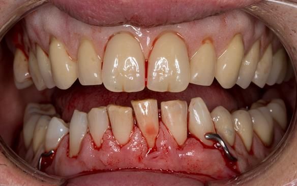 Figure 43 Visit 2 fitting of Mk 1 upper complete and lower partial immediate dentures