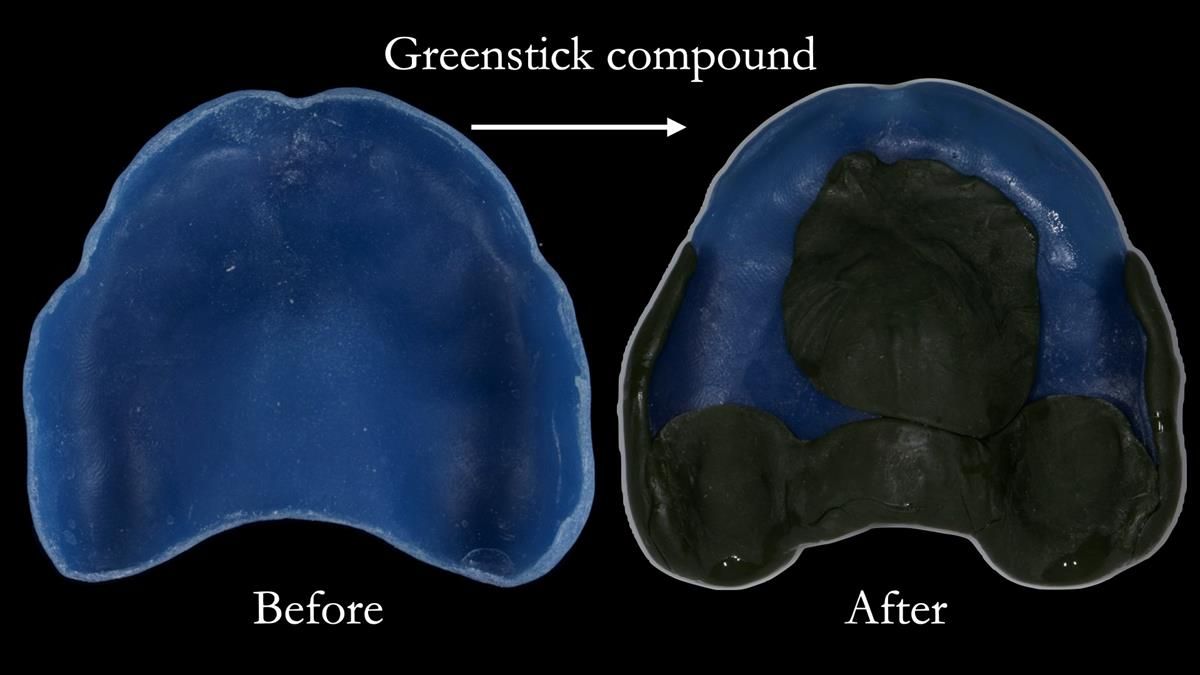 Fin’s Newsletter 88 — Complete dentures - full protocol… he rearranged his own teeth!
