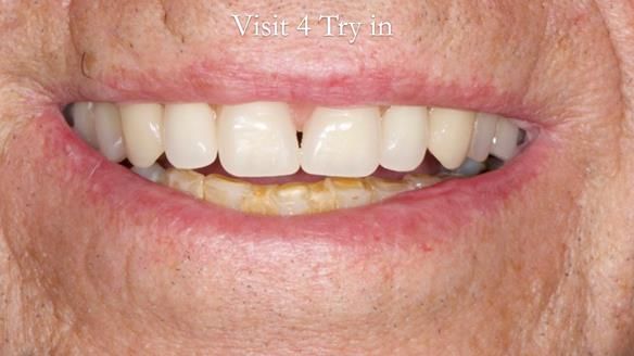 Newsletter 54 case presentation upper complete denture and lower Scandinavian designed hygienic partial denture for David