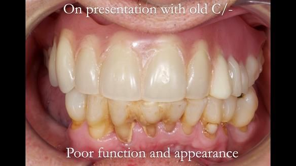 Newsletter 54 case presentation upper complete denture and lower Scandinavian designed hygienic partial denture for David