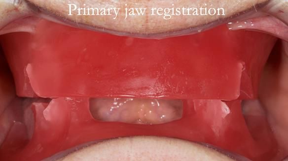 Newsletter 75: Marion’s case - Step-by-step complete denture workflow