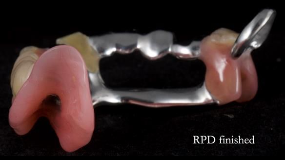 Newsletter 55 Provision of metal based partial dentures for Zephyrine with a repaired cleft lip and palate