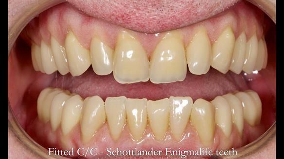 Complete denture Class II div 2 deep overbite Newsletter 39