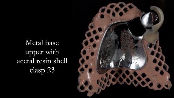 Newsletter 55 Provision of metal based partial dentures for Zephyrine with a repaired cleft lip and palate