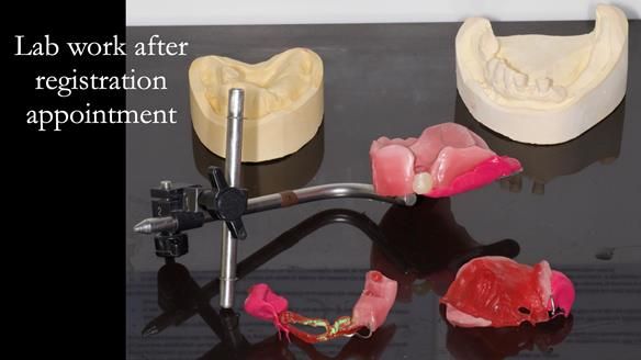 Newsletter 55 Provision of metal based partial dentures for Zephyrine with a repaired cleft lip and palate