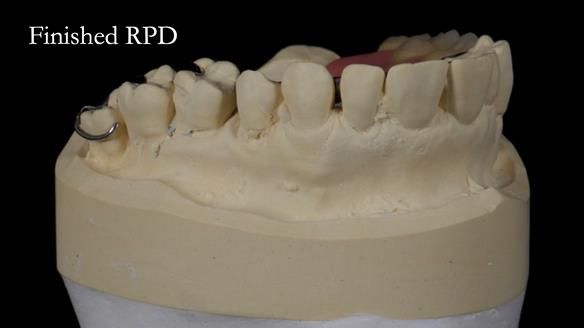 Finlay's Newsletter 64 case study - provision of a Kennedy class 2 metal based Scandinavian RPD for Ian