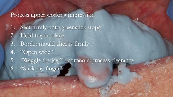 A very thin mix of alginate (avoiding over filling the tray) is applied and glazed with water. The same trimming and movements are performed as with greenstick application, with the addition of sucking firmly for 1 second. Keep the periphery thin in the