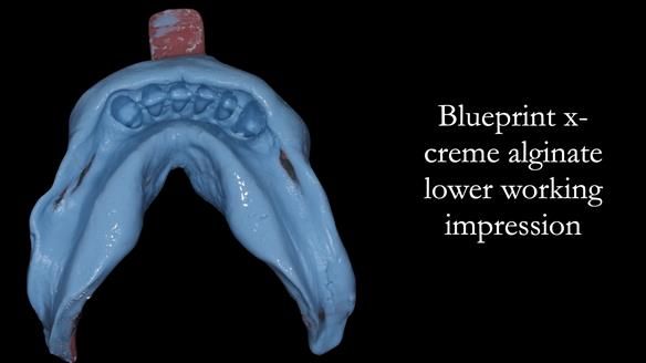 Newsletter 52 Managing Jo’s failing dentition with extractions and Mk 1/Mk 2 complete upper dentures and lower partial dentures FULL PROTOCOL
