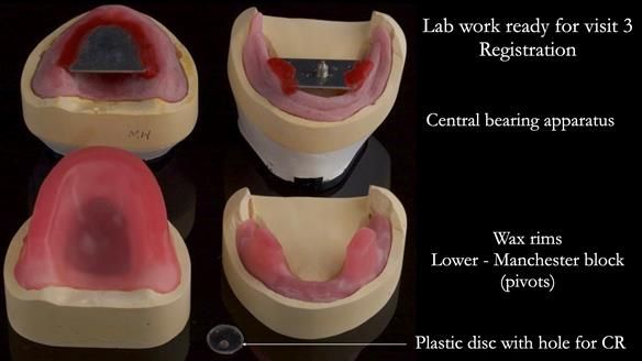 Complete denture Class II div 2 deep overbite Newsletter 39