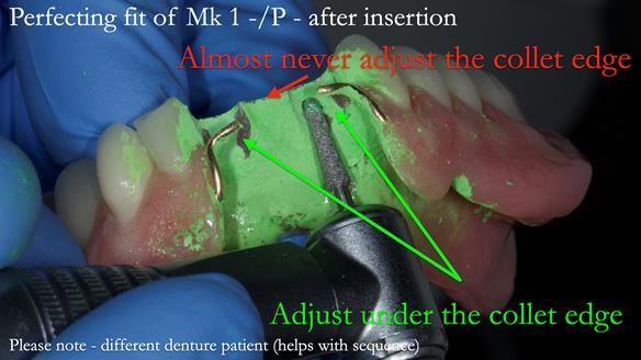 Newsletter 54 case presentation upper complete denture and lower Scandinavian designed hygienic partial denture for David
