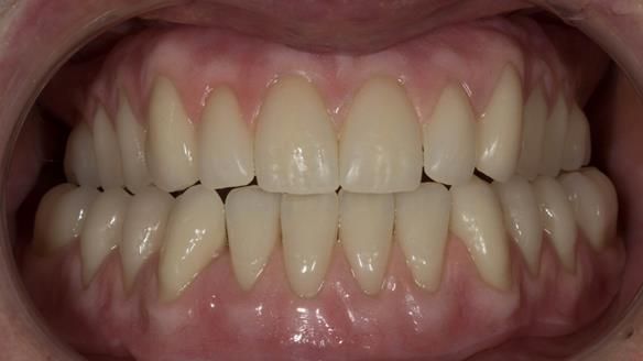 Finished dentures - mimicking Mary’s daughters natural teeth