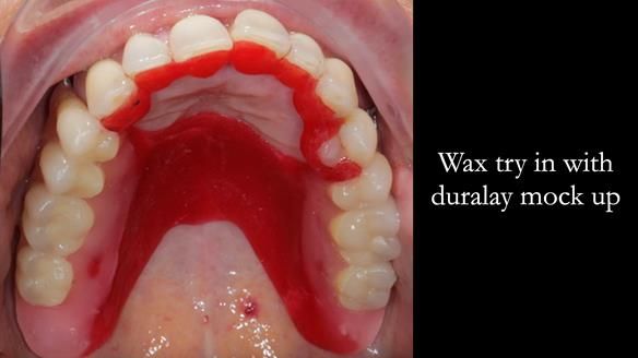 Newsletter 56 showing the making and fitting of a bilateral free end saddle upper removable partial denture (RPD) for patient with pemphigus