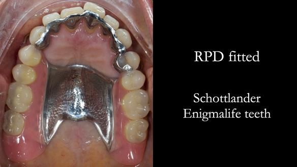 Newsletter 56 showing the making and fitting of a bilateral free end saddle upper removable partial denture (RPD) for patient with pemphigus