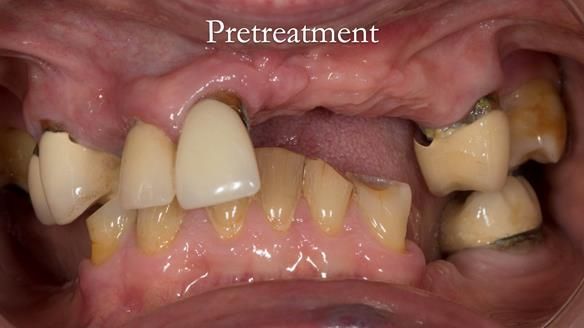 Eileen's transformation with upper and lower RPDs of Scandinavian hygienic design FULL PROTOCOL