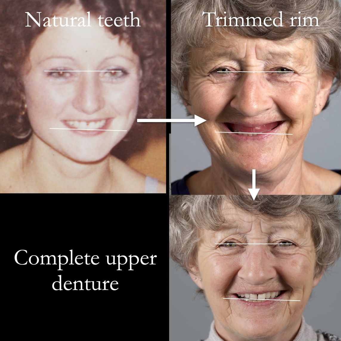 Where to position the upper incisal plane