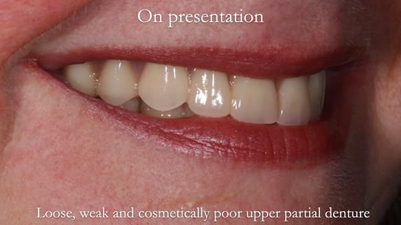 Finlay's Newsletter 58 Gasket upper partial denture for Zoe