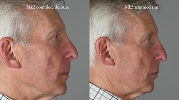 Newsletter 77: Jeremy’s case – immediate complete upper denture