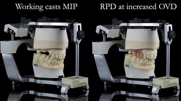 Finlay's Newsletter 60 Sylvia's upper Kennedy Class 2 Mod 1 metal based upper RPD