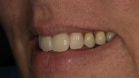 Finlay's Newsletter 63 Case study provision of metal based Scandinavian RPD - functional 10 years on