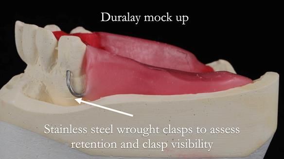 Newsletter 56 showing the making and fitting of a bilateral free end saddle upper removable partial denture (RPD) for patient with pemphigus