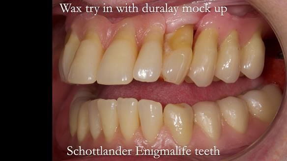 Finlay's Newsletter 59 Ultra hard partial dentures made for Gill