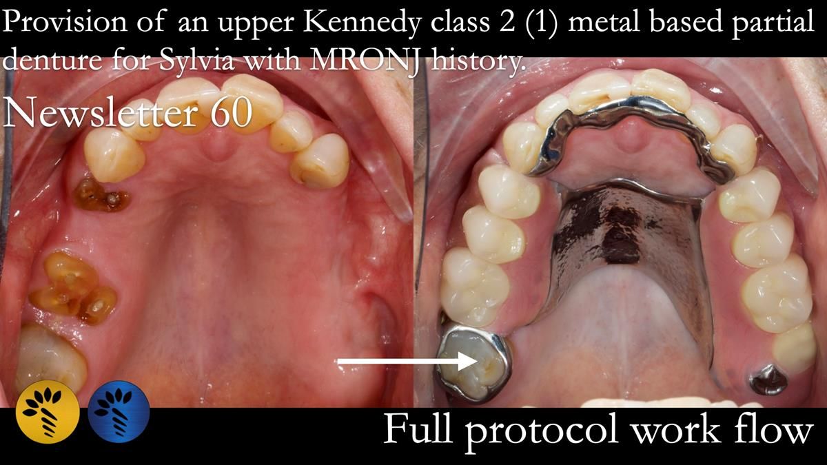 Finlay's Newsletter 60 Sylvia's upper Kennedy Class 2 Mod 1 metal based upper RPD