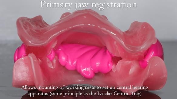 Finlay's Newsletter 59 Ultra hard partial dentures made for Gill