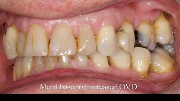 Finlay's Newsletter 64 case study - provision of a Kennedy class 2 metal based Scandinavian RPD for Ian