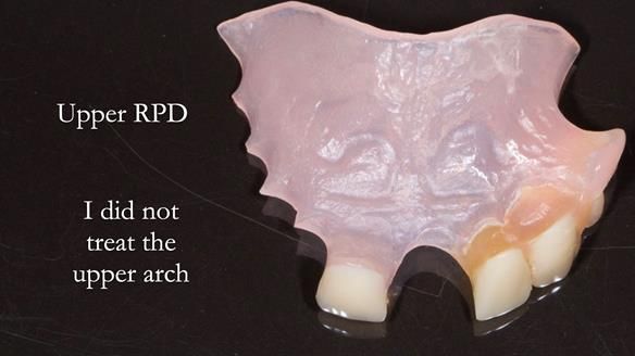 Newsletter 44 - extreme removable prosthodontics – engineering a super-strong and ultra-thin over denture