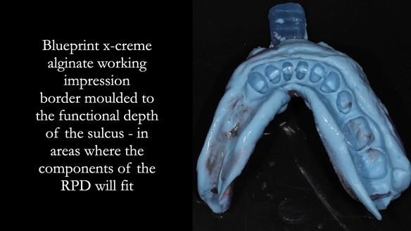 Finlay's Newsletter 61 provision of a lower unilateral free end saddle metal based partial denture for Joyce