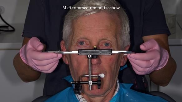 Newsletter 77: Jeremy’s case – immediate complete upper denture