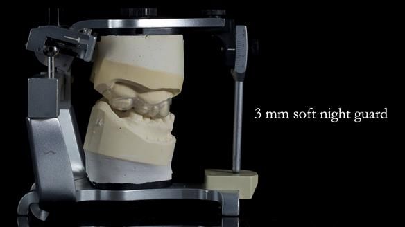 Newsletter 81 - Pam’s Story — how a partial denture changed her life (+ live walkthrough this Thursday)