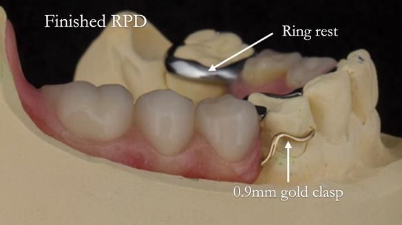 Eileen's transformation with upper and lower RPDs of Scandinavian hygienic design FULL PROTOCOL