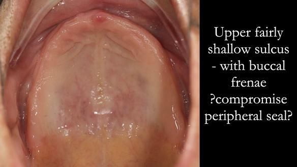 Managing poor implant positioning with complete dentures and Locator attachments - full protocol Newsletter 41