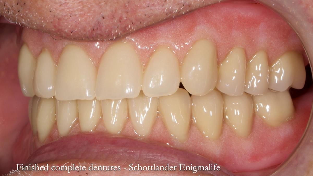 Fin’s Newsletter 88 — Complete dentures - full protocol… he rearranged his own teeth!
