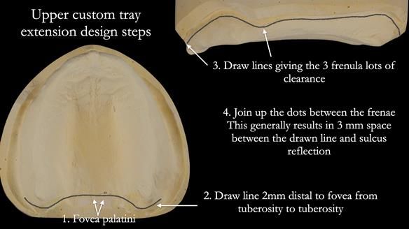Newsletter 53 showing the making and fitting of ultra life-like dentures for Valena