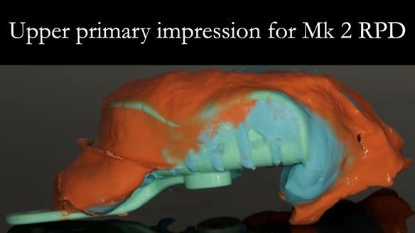 Finlay's Case Study Newsletter 40 - Immediate Mk 1 RPD to Definitive Mk 2 RPD - full protocol