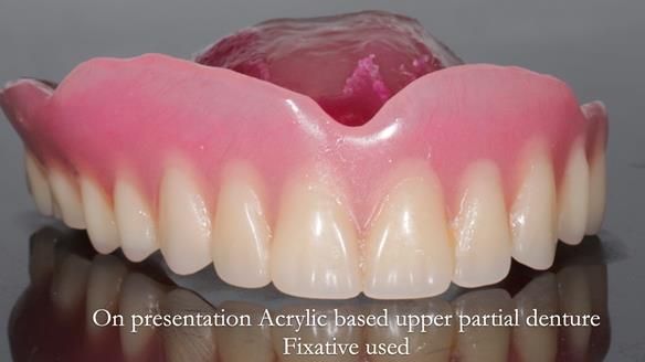 Finlay's Newsletter 58 Gasket upper partial denture for Zoe