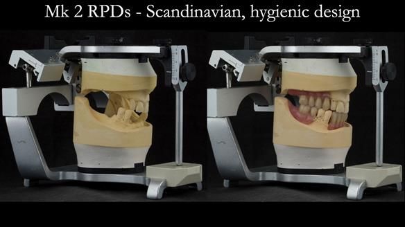 Finlay's Case Study Newsletter 40 - Immediate Mk 1 RPD to Definitive Mk 2 RPD - full protocol