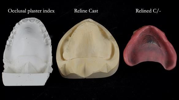Newsletter 54 case presentation upper complete denture and lower Scandinavian designed hygienic partial denture for David