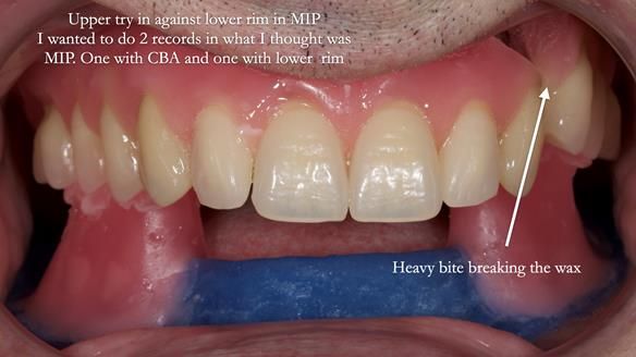 Newsletter 80 - Gordon’s dentures: the one case in 1,000 where my technique failed
