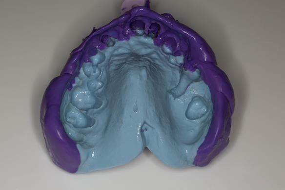 Figure 18 The two parts of the impression are fitted back together and glued with superglue (cyanoacrylate adhesive)
