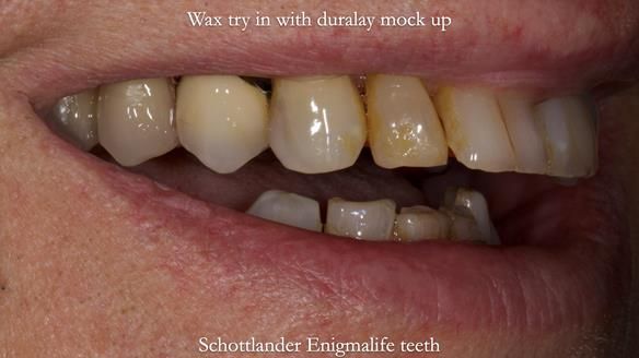 Finlay's Newsletter 64 case study - provision of a Kennedy class 2 metal based Scandinavian RPD for Ian