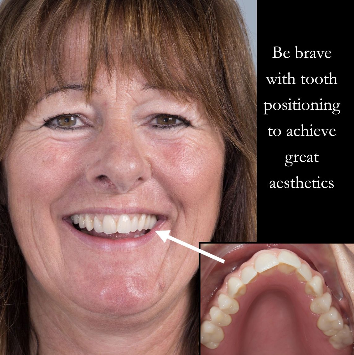 Be brave with your tooth positioning 