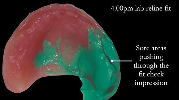 Newsletter 52 Managing Jo’s failing dentition with extractions and Mk 1/Mk 2 complete upper dentures and lower partial dentures FULL PROTOCOL