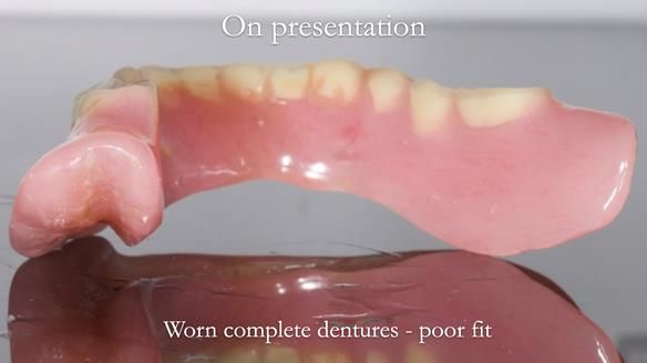 Newsletter 57 showcases the making and fitting process of implant-supported complete dentures for Alisdair